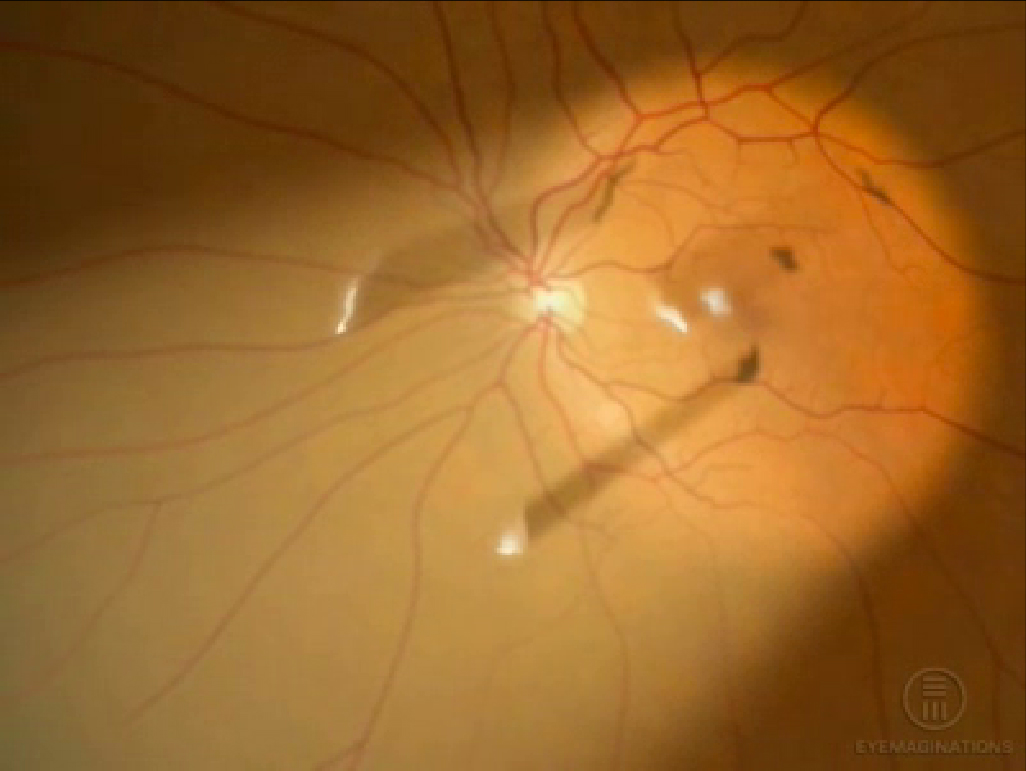 Showing picture: Vitreous Floaters Floater