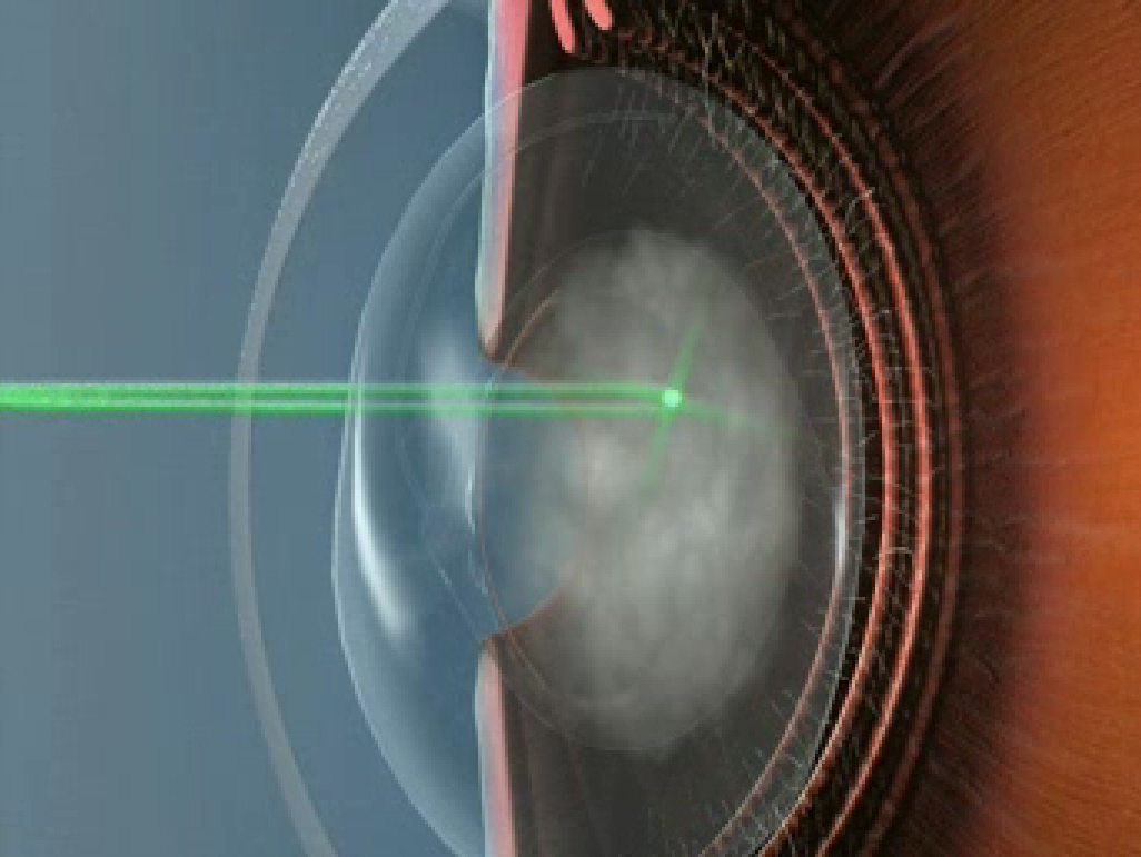 Is Yag Laser Necessary After Cataract Surgery - Printable Templates Protal